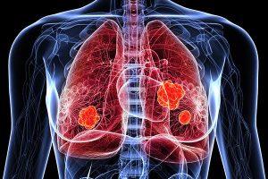 Best Cancer Treatment In Chembur
