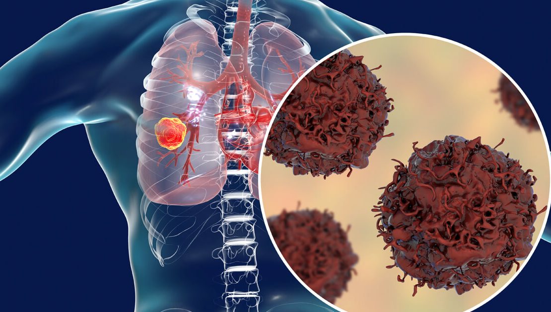 Best Cancer Treatment In Chembur