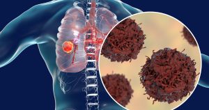 Best Cancer Treatment In Chembur