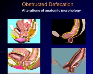 Obstructive Defecation Syndrome