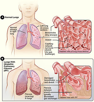 Pulmonary Fibrosis