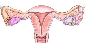 endometrial cancer
