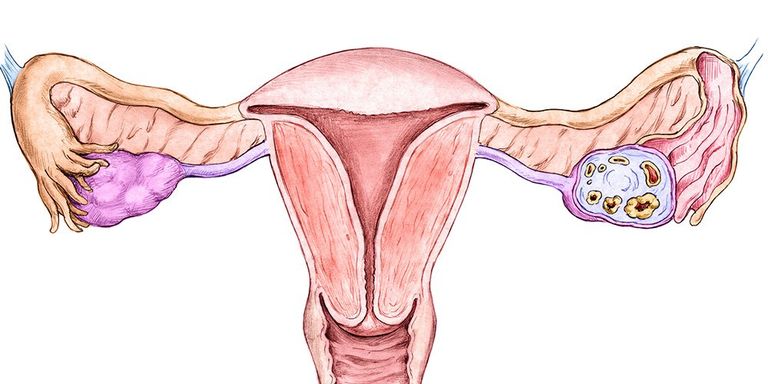 endometrial cancer