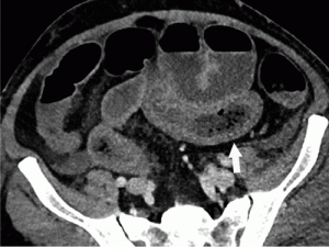 inflammotory-small-bowel-thickening-CT