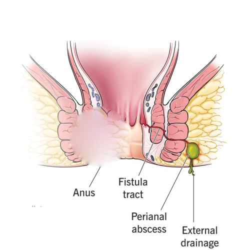 Anal Fistul