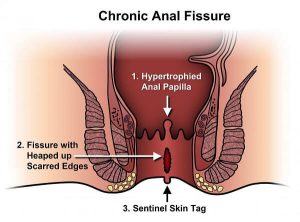 Fissure Surgery Hospital in Chembur, Mumbai