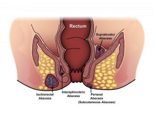 Fistula Specialist doctor in Mumbai