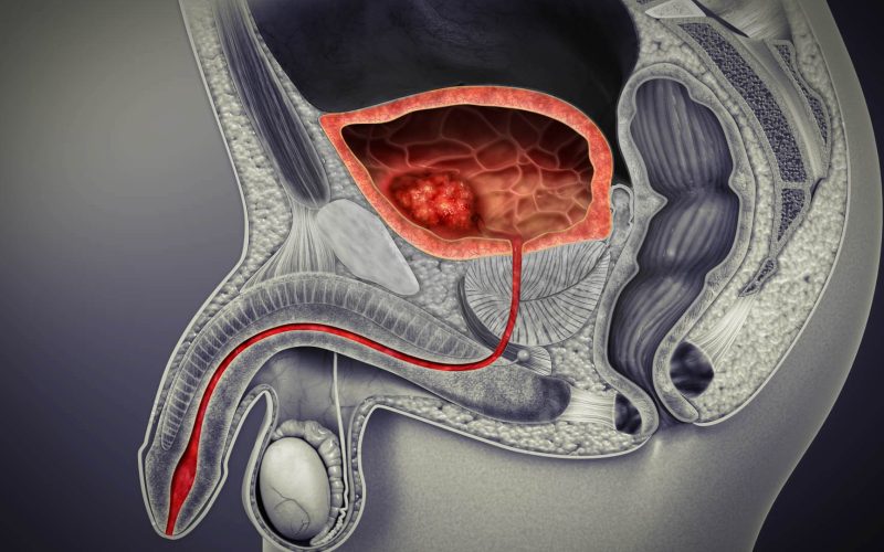 Bladder Cancer