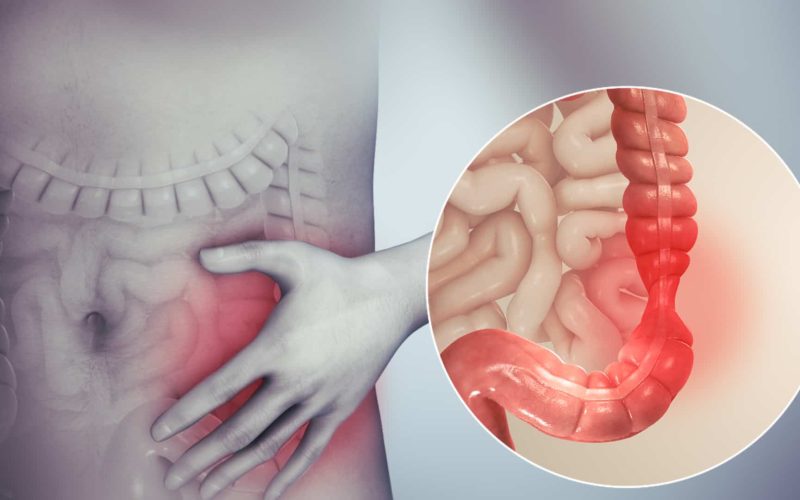 Irritable_bowel_syndrome