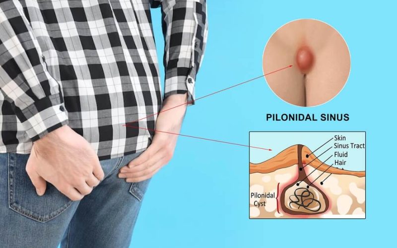 Pilonidal-Sinus (1)