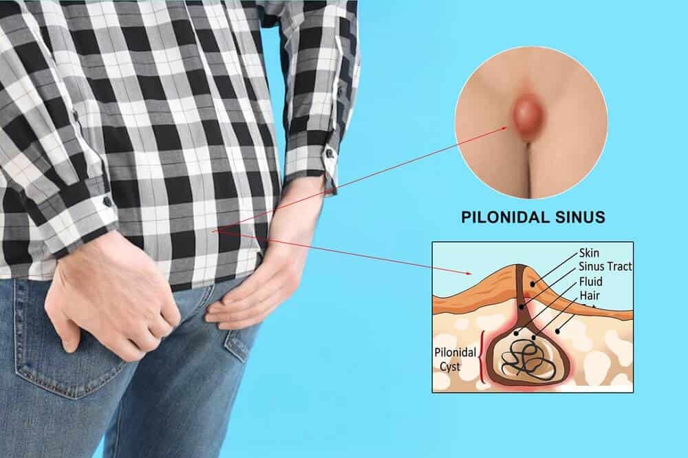 Pilonidal sinus