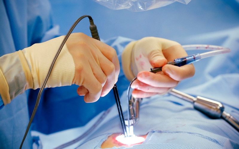 LASER PILES TREATMENT