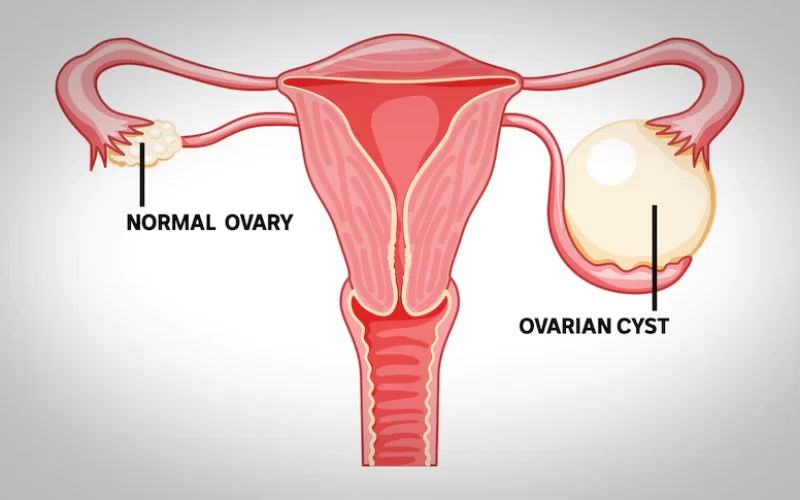 OVARIAN CYSTS