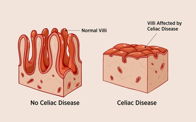 CELIAC DISEASE