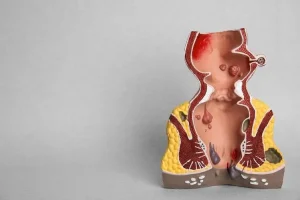 Fistula treatment in Chembur, Mumbai