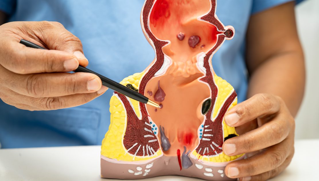 Haemorrhoids